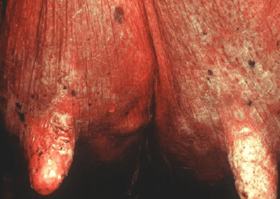 Foot and Mouth Disease