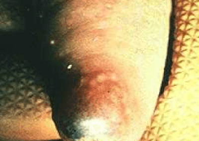 Foot and Mouth Disease