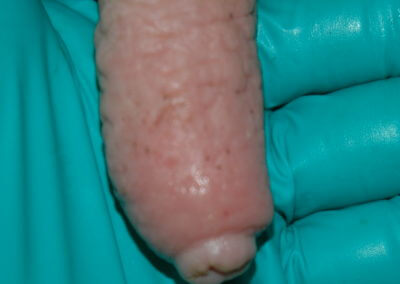 Orifice Hyperkeratosis, Eversions, Erosions and Open