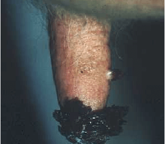 Papilloma