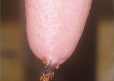 Papilloma