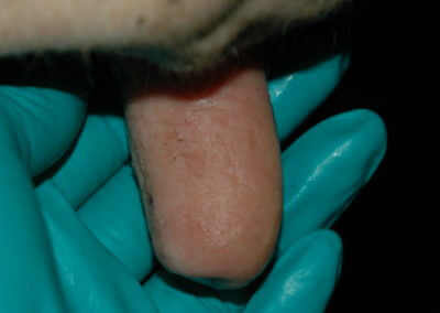 Orifice Hyperkeratosis, Eversions, Erosions and Open