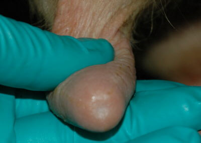 Orifice Hyperkeratosis, Eversions, Erosions and Open