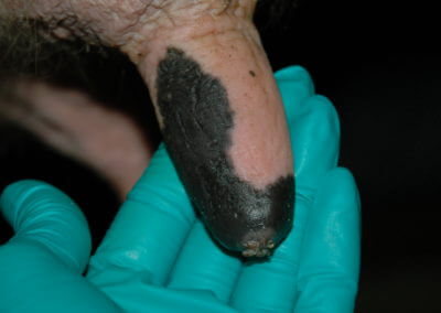 Orifice Hyperkeratosis, Eversions, Erosions and Open
