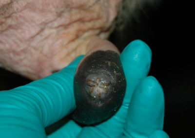 Orifice Hyperkeratosis, Eversions, Erosions and Open