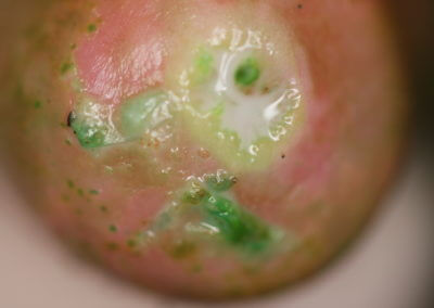 Chemical Exfoliation