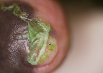 Chemical Exfoliation