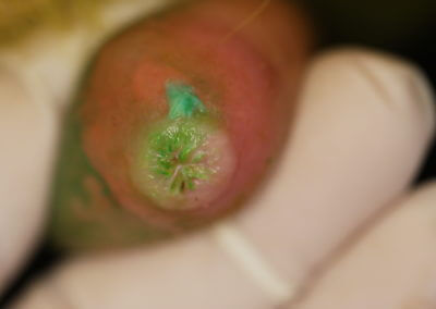 Chemical Exfoliation