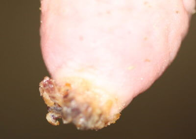 Hyperkeratosis