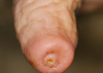 Typical Range of Teats (Normal Teats)