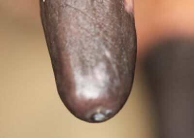 Typical Range of Teats (Normal Teats)