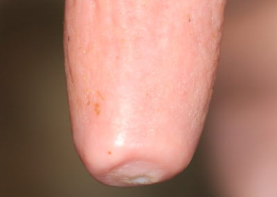 Typical Range of Teats (Normal Teats)