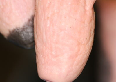 Typical Range of Teats (Normal Teats)