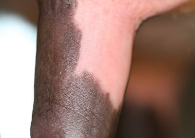 Typical Range of Teats (Normal Teats)