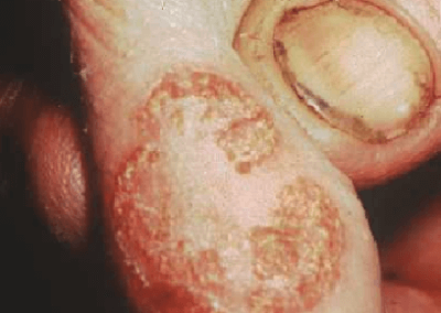 Pseudocowpox