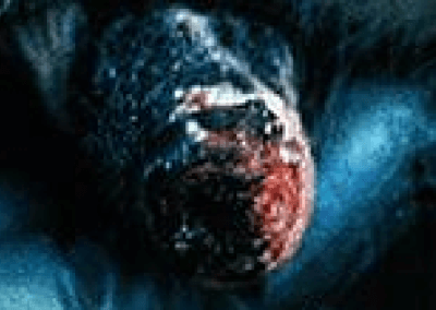 Vesticular Stomatitis